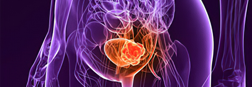 Bladder Cancer
