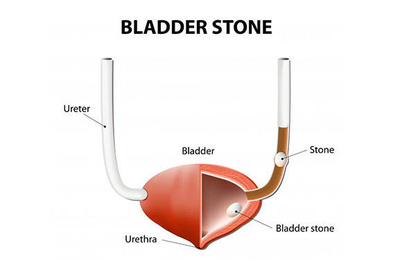 Ureter and Bladder Stone