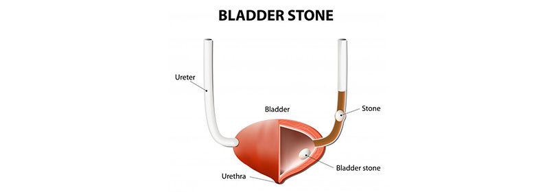 Ureter and Bladder Stone